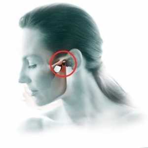 Artritis temporomandibularnog zgloba: liječenje, simptomi, dijagnoza