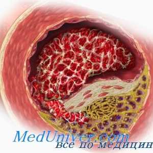 Ateroskleroza je u menopauzi i menopauzi. Učinak testosterona na arteriosklerozu androgena