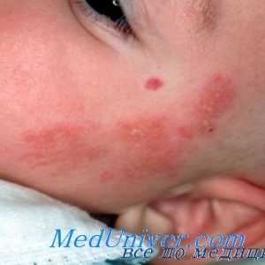 Atopijski atopijski dermatitis. razlozi