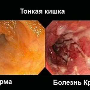 Crohnova bolest i ulcerozni kolitis