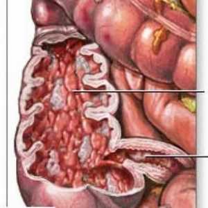 Bolest tankog crijeva Crohnova