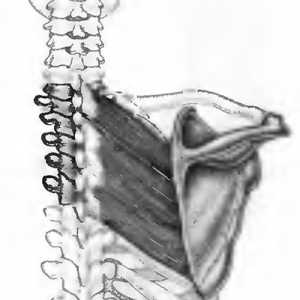 Bol u leđima uzrokovana romboidnog mišića