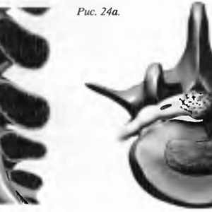 Bol u leđima hernija pulpozna jezgra (disk hernija)