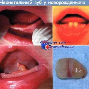 Neonatalne zuba novorođenče uzroci, dijagnoza