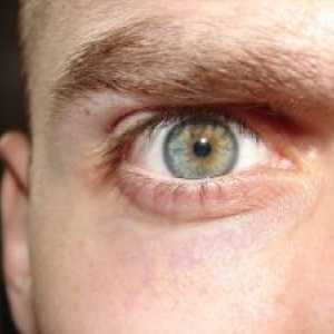 CMV retinitis: simptoma, liječenje, dijagnozu, prevenciju