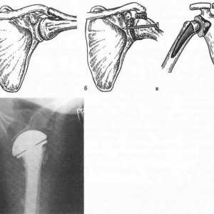 Deformacijom artroza zglobova gornjeg ekstremiteta