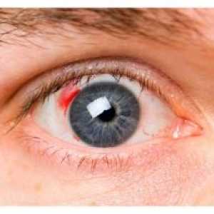 Dijabetička retinopatija: simptomi, liječenje, stadij, komplikacije