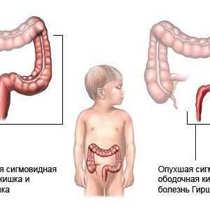 Dolichosigma crijeva u djece