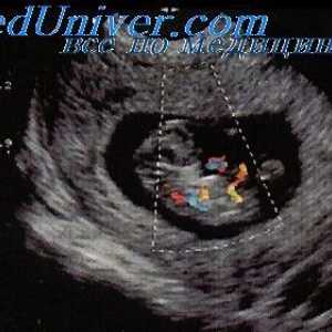 Dopler ultrazvuk fetusa. Protok studija krvi u fetusa duktusa venski