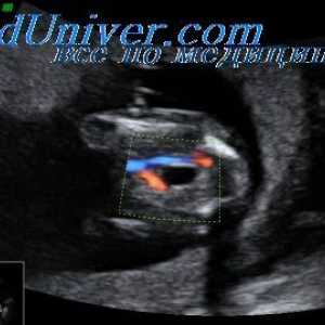 Točnost Doppler fetalni srca. Doppleroehograficheskie performanse srce fetusa