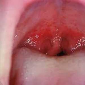 Faringitis gastritisa