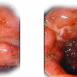 Oblici i faze Crohnove bolesti
