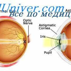 Kontaktne leće. Vizija s katarakte