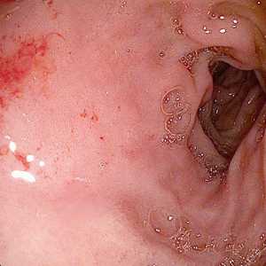 Gastritisa, erozivnog duodcnitisa