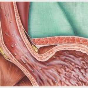Bolest gastroezofagealnog refluksa: simptomi, liječenje, uzroci, simptomi