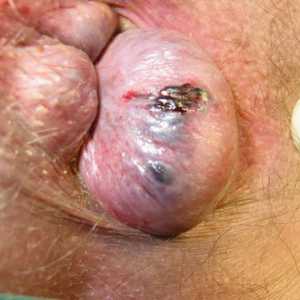 Hemoroidi i infekcije, liječenje zaraznih bolesti