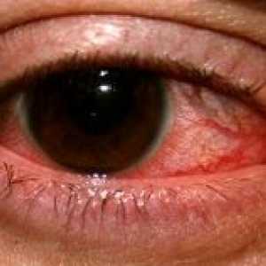 Hcrpctički keratitis očiju: liječenje, prevencija, simptomi, uzroci