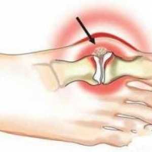 Hidroksiapatita artropatija: simptomi, uzroci, liječenje, simptomi