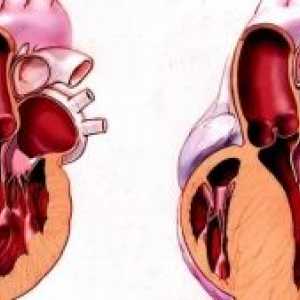 Hipertrofična kardiomiopatija: Liječenje, simptomi