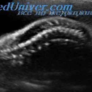 Hipoplazija stanica dojke fetusa. Hondroektodermalnaya displazija