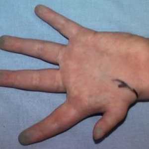 Hipoplazija od prvih prstiju