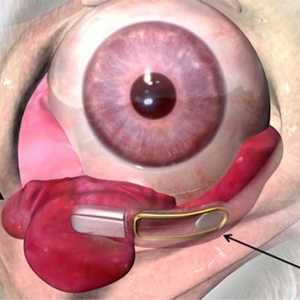 Očna implantat za liječenje Xerophthalmia