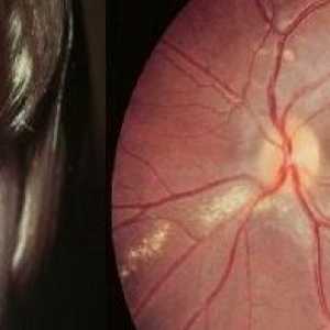 Očni toxocariasis, simptomi i tretman kod odraslih