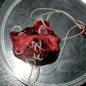 Worms (helminti) u jetri, liječenje jetre Helmintiaza u djece i odraslih