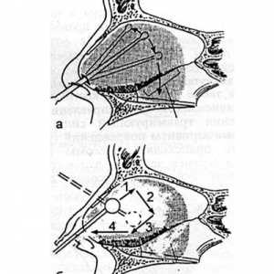 Kirurgija nosa septuma. Pristup i vrste operacija na nosnoj septuma