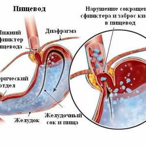 Kronični gastritis kardija insuficijencija, srčani, atrofični sekundarnom i njegove varijante