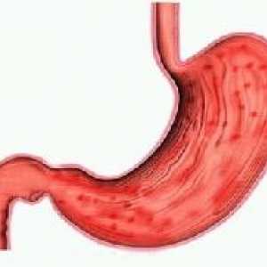 Kronični gastritis sa žarišnom mukozne atrofije simptoma, liječenje i prehrane