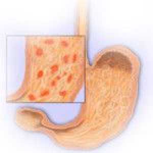 Kronična erozivni gastritis, njegovi simptomi i prehrana pomoć u liječenju