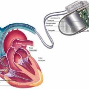 Implantirati i elektrostimulator