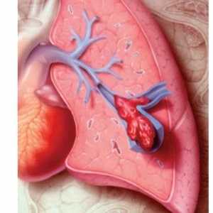 Plućna embolija: Simptomi, liječenje