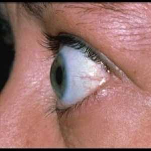 Endokrini oftalmopatija: liječenje, simptomi, dijagnoza, klasifikacija