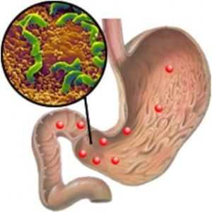 Erozivni gastritis i Helicobacter pylori