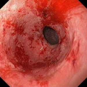Erozivni gastritis s hemoragijska komponentom, uz erozije, simptomima i liječenju narodnih lijekova