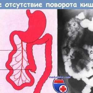 Faze razvoja crijeva. Rotirati (širiti) fetalnog crijeva