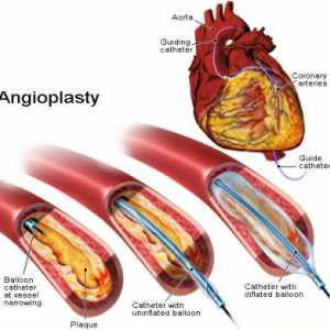 Koronarna angioplastika