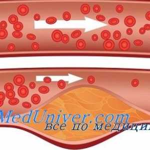 Kožne krvne žile u diabetes mellitus. Mikroangopatije u dijabetes