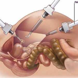 Laparoskopija gušterače u pankreatitisa