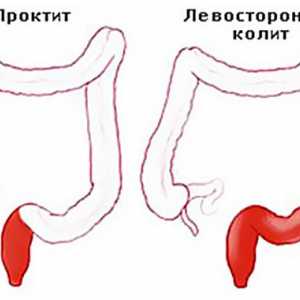 Lijevo jednostrana kolitis, crijeva