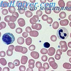 Uništavanje hemoglobina. razne anemije