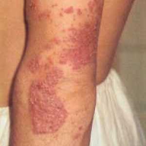 Miniatlas: kožne bolesti uz svrbeža