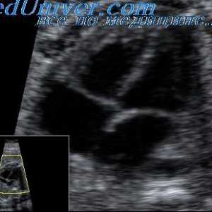 Srčanog ritma abnormalnosti u fetusa. Pretklijetke i ventrikularna aritmija fetus