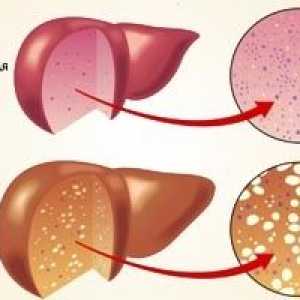 Bezalkoholno bolest masne jetre: liječenje