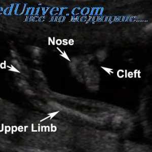 Procjena protoka krvi u fetusa s IUGR. Procjena protoka krvi u silaznu aortu