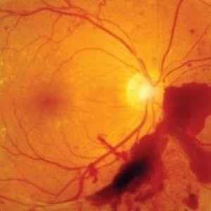 Okluzija središnje retinalne arterije: liječenje, uzroci, dijagnoza