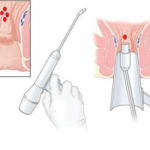 Kirurgija za uklanjanje hemoroide laserski trenutni liječenje hemoroida