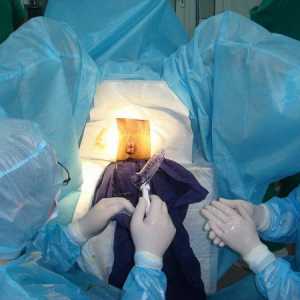 Kirurgija za uklanjanje vanjske (izvan) hemoroide